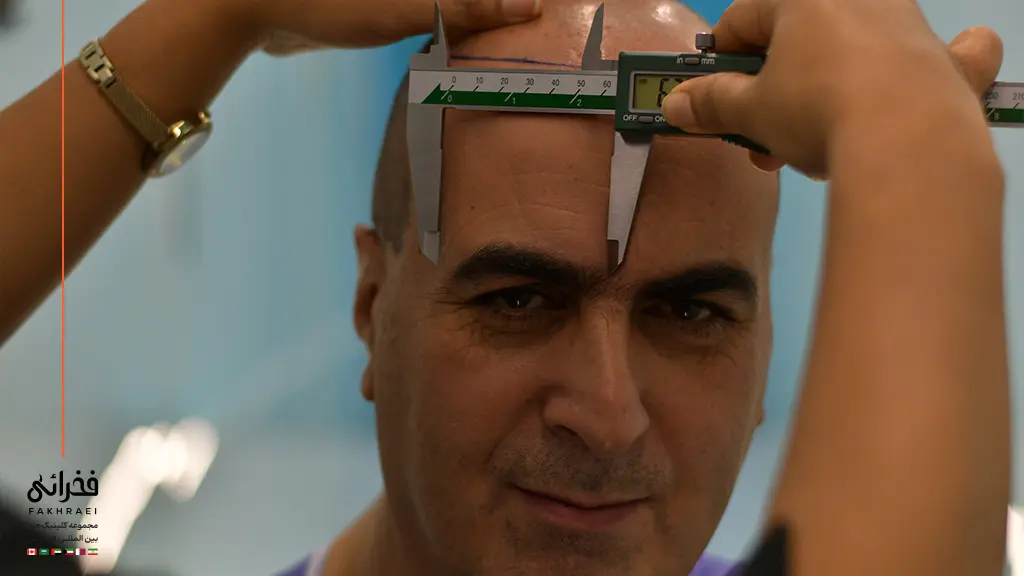 طراحی خط رویش مو برای کاشت موی کم پشت