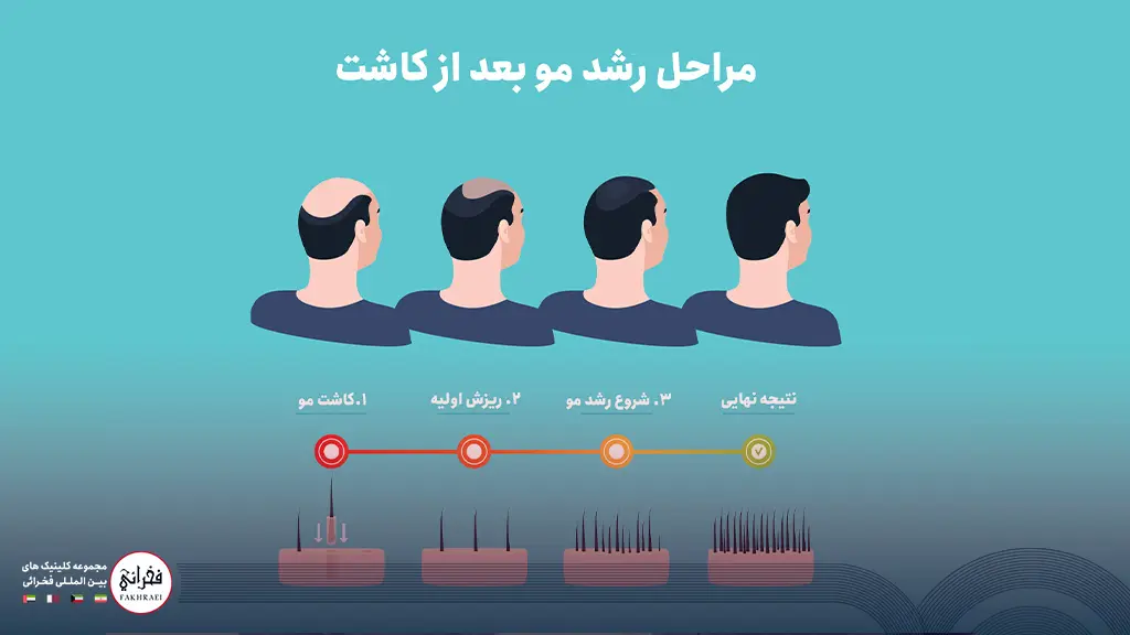 تصویر مراحل رشد مو پس از کاشت