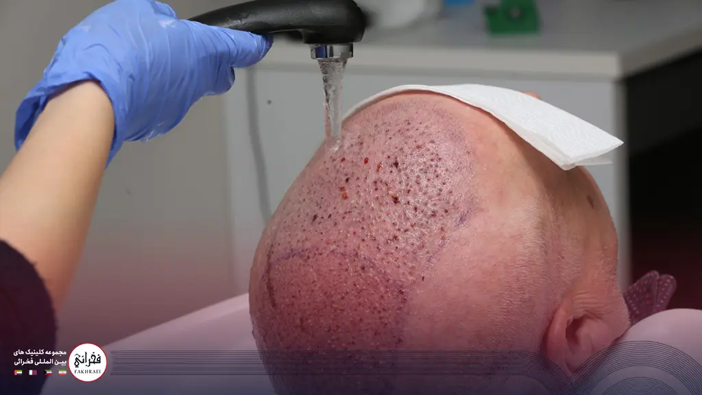 شستشوی ناحیه کاشت مو توسط یک متخصص