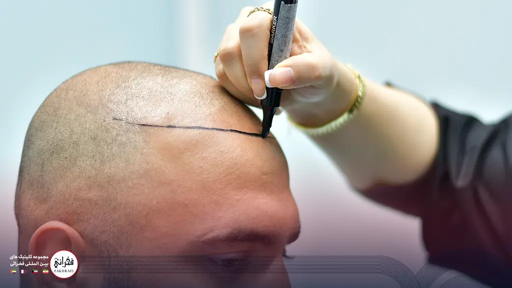 متخصص در حال طراحی خط مو پیش از کاشت مو جلوی سر