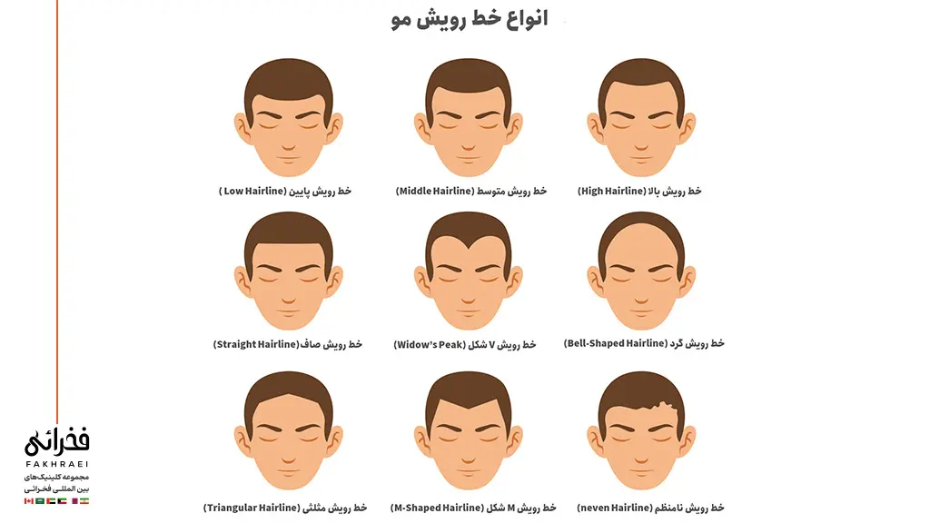 انواع خط رویش مو