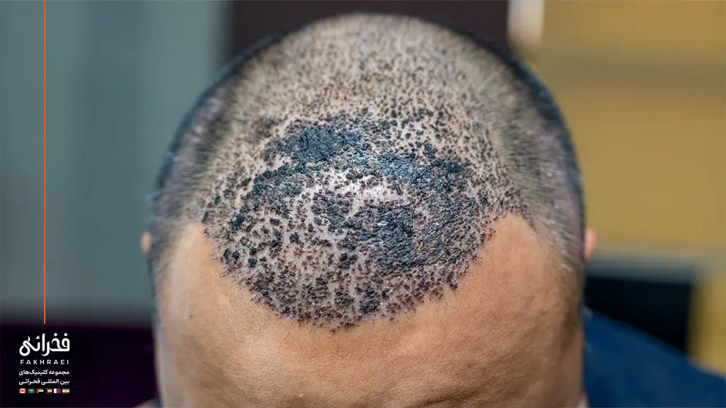 دلمه کاشت مو علت خارش سر پس از کاشت