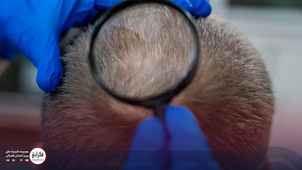 معاینه سر یک فرد برای مناسب بودن کاشت مو