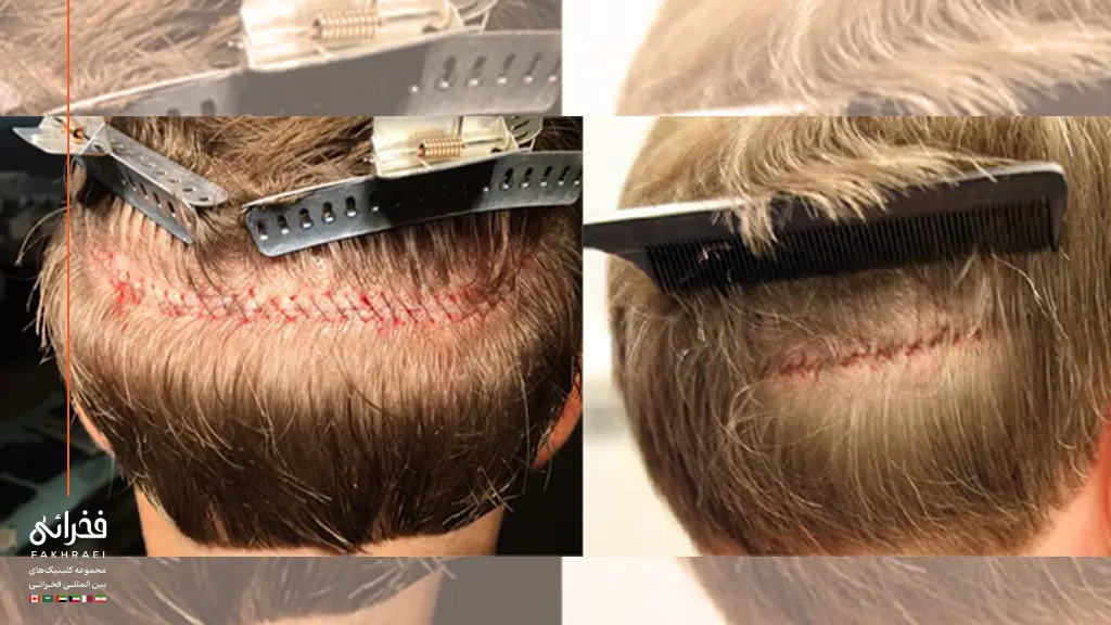 زخم روی سر در کاشت به روش FUt