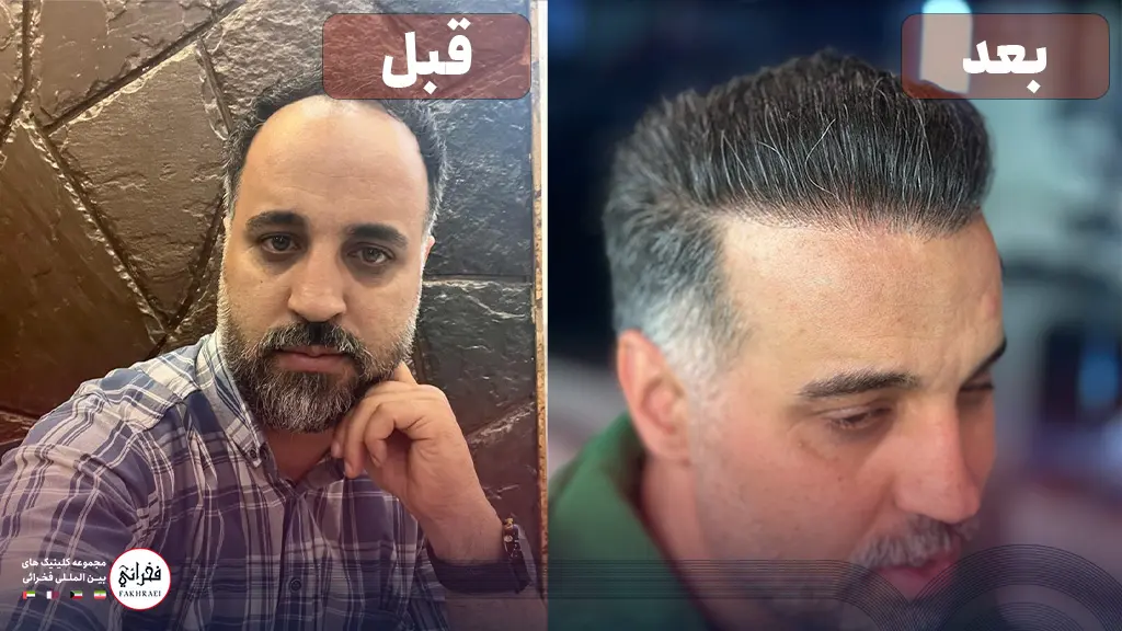 عکس قبل و بعد از تراکم بالای کاشت مو