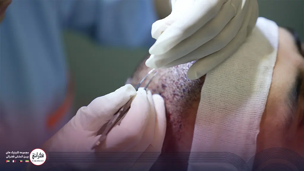 انجام کاشت مو جلوی سر با روش FIT