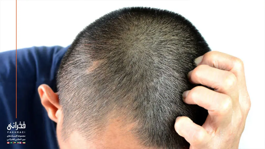 یک مرد درگیر خارش بعد از کاشت مو