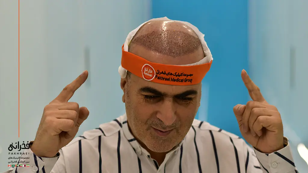 یک مرد پس از کاشت مو برای موهای کم پشت