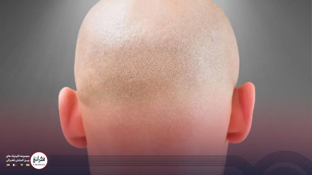 نداشتن بانک مو