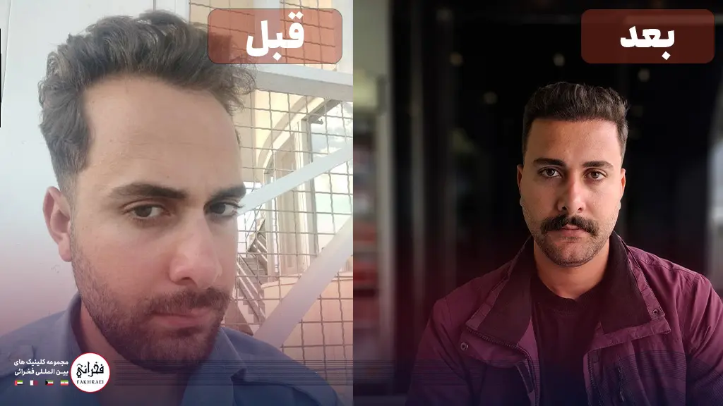 تصویر قبل و بعد از یک مرد پس از کاشت مو در جلوی سر
