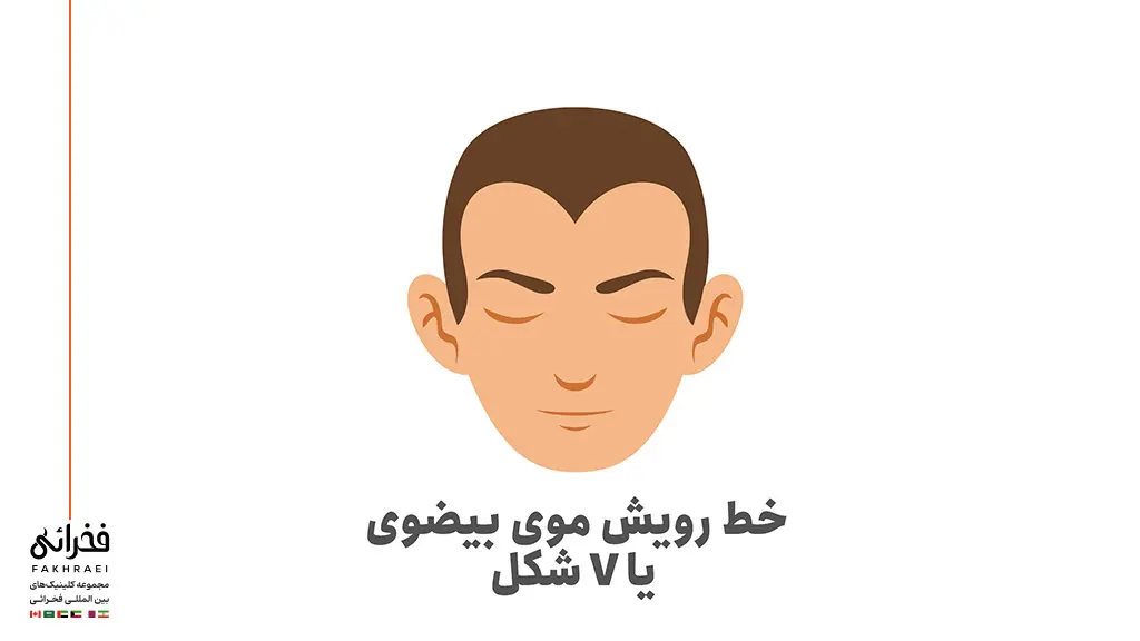 خط رویش موی V شکل