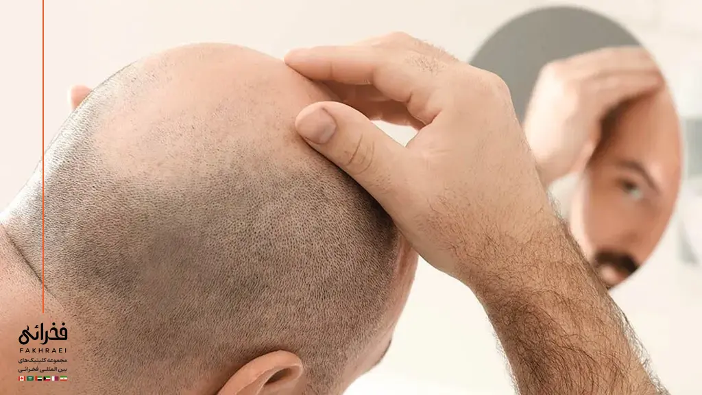 یک مرد در حال پیدا کردن علت خارش سر بعد از کاشت مو