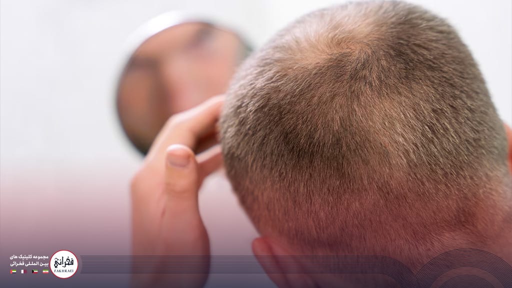 ضعیف شدن بانک موی سر یک مرد