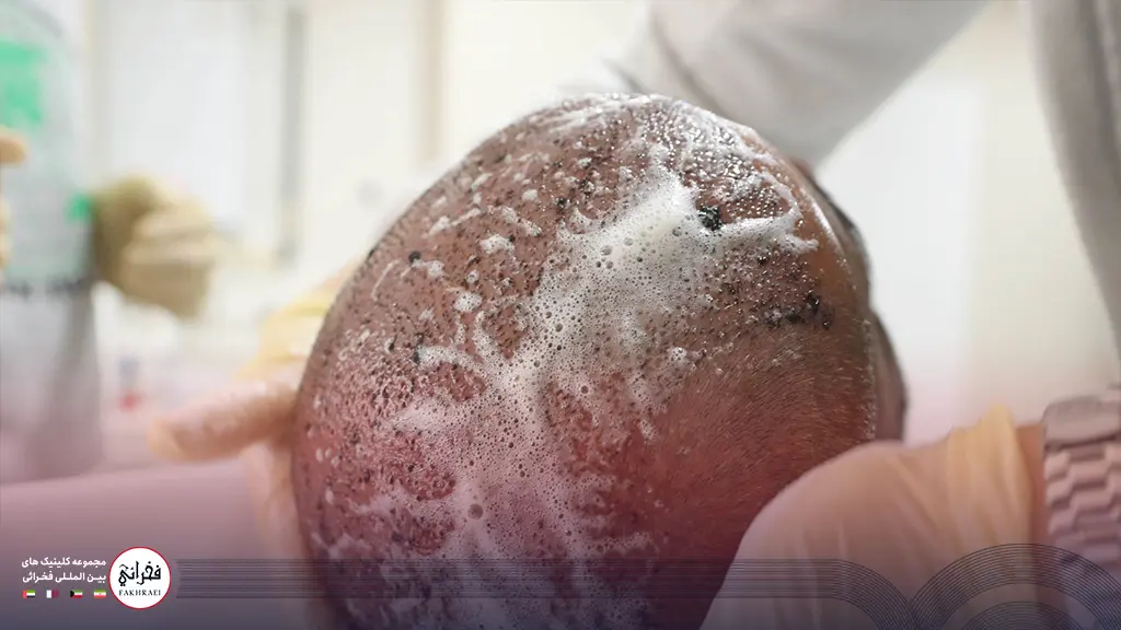 شستن دلمههای کاشت مو