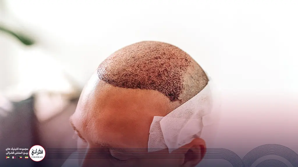 چه زمانی دلمهها تشکیل میشوند؟