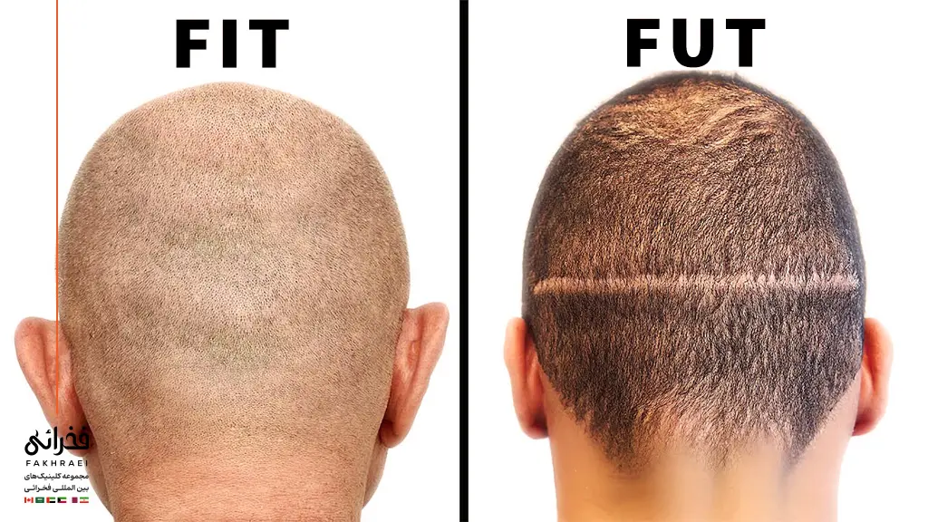 تفاوت دو روش FIT و FUT برای کاشت مو