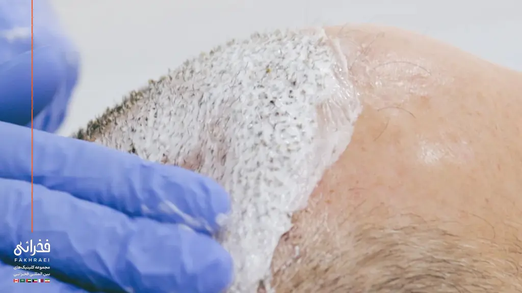 استفاده از مرطوب کننده برای جلوگیری از خارش سر بعد از کاشت مو