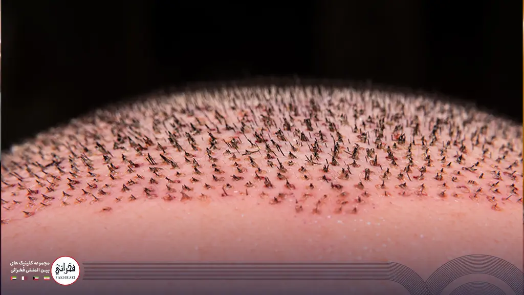 ایجاد دلمه در اثر کاشت مو