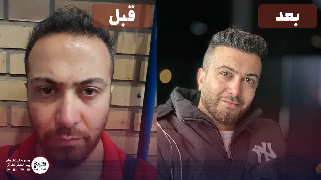 تصویر مقایسه قبل و بعد از کاشت مو جلوی سر