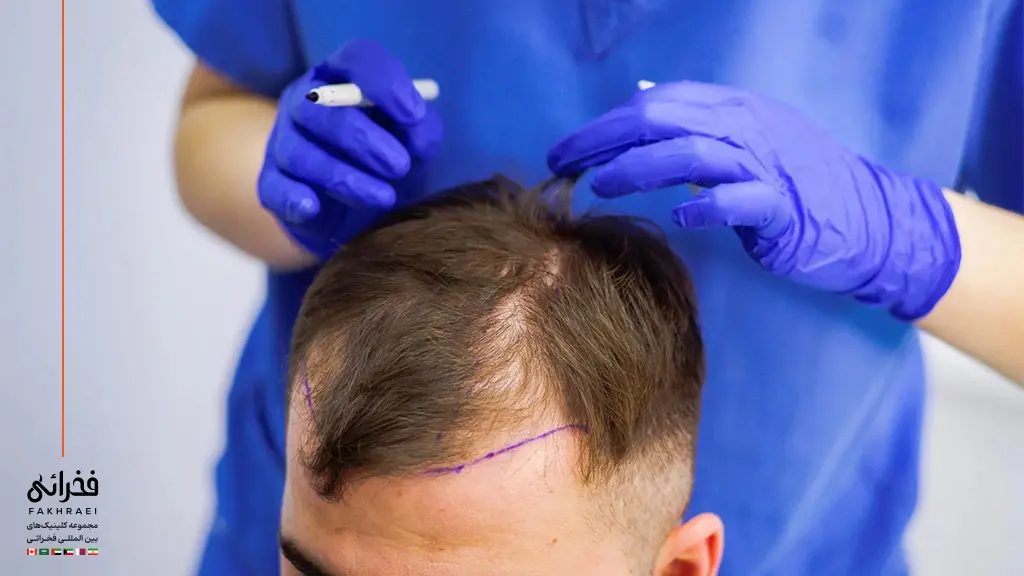 چه کسانی کاندیدای مناسب برای کاشت موی شقیقه هستند؟