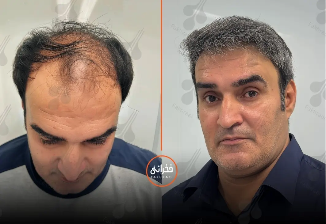 یک مرد قبل و بعد از کاشت مو برای موهای کم پشت
