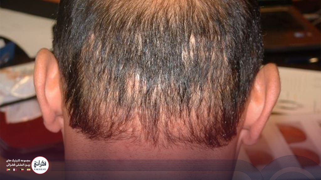 تصویری از یک مرد با بانک موی ضعیف