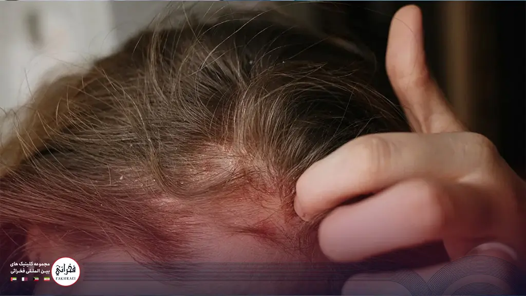 یک زن با بیماری پوستی که کاشت مو برای او مناسب نیست