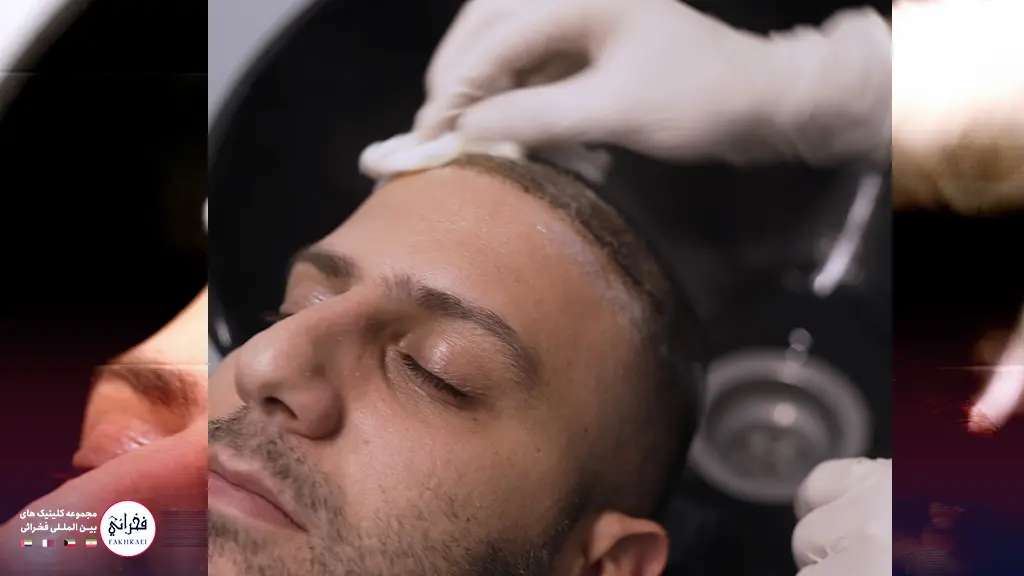 شستن سر بعد از کاشت مو در کلینیک فخرائی