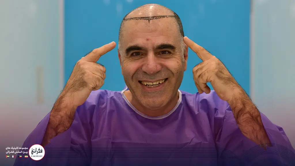 تصویر یک مرد پیش از انجام کاشت مو در جلوی سر
