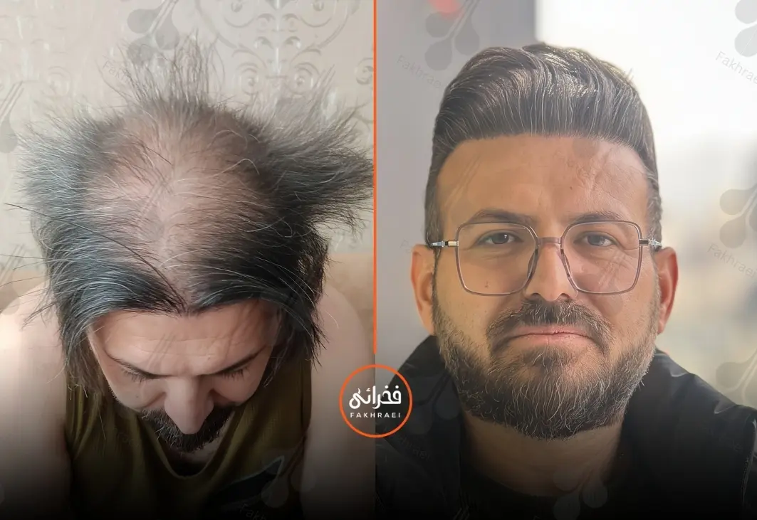 تصویر یک مرد قبل و بعد از درمان کم‌ پشتی موی سر با کاشت مو