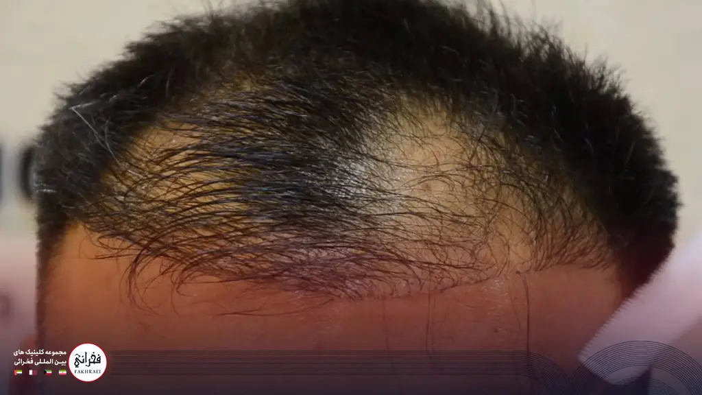 علائم کاشت مو ناموفق