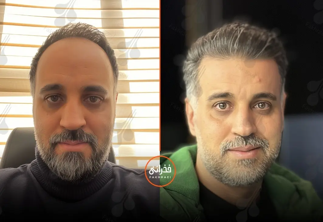 موفقت کاشت مو برای موهای کم پشت