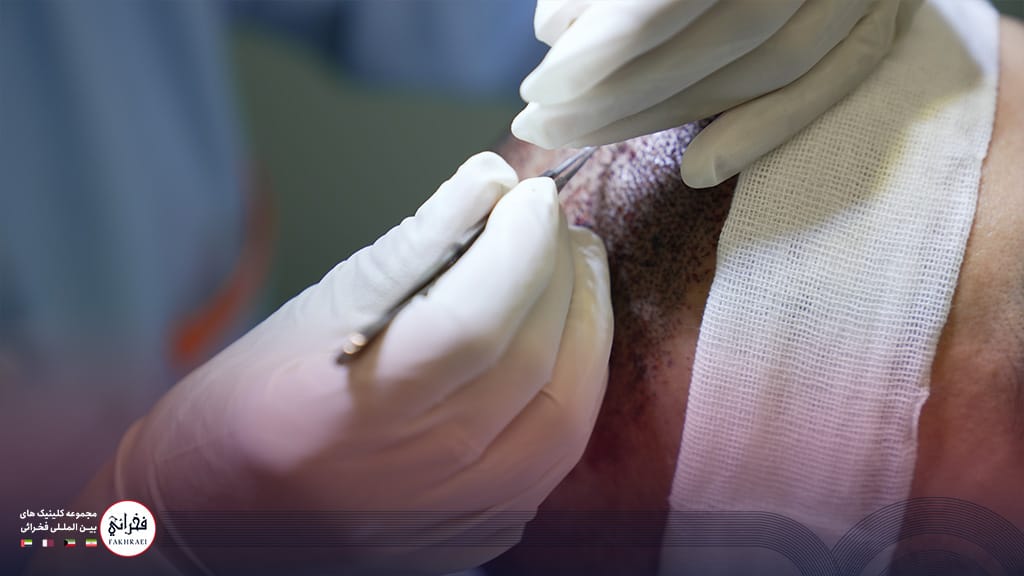 انجام کاشت مو برای یک فرد با بانک موی ضعیف