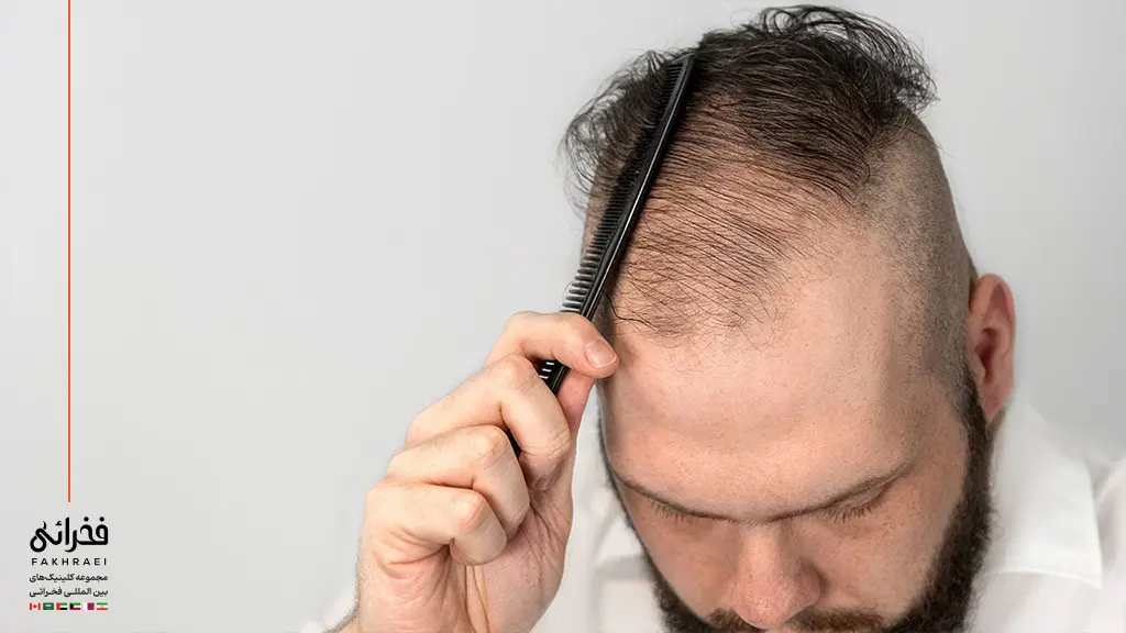 کم پشت شدن موها در یک مرد