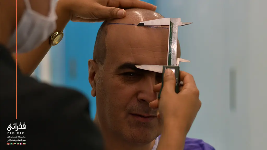 طراحی خط مو برای کاشت