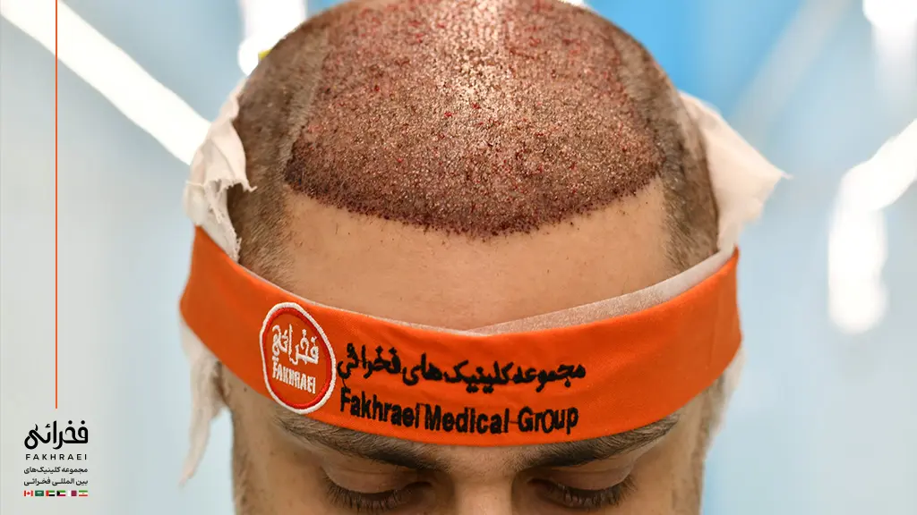 ترمیم خط مو با کاشت