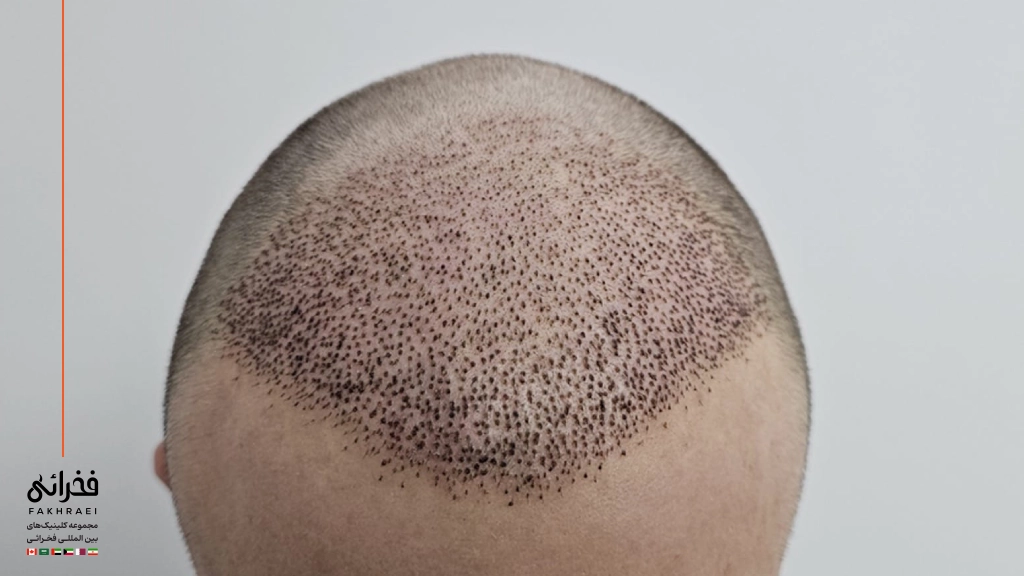 دلمه و پوسته بعد از کاشت مو