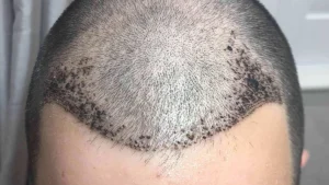 ۱۰ روز بعد از کاشت مو