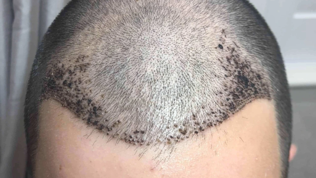 ۱۰ روز بعد از کاشت مو