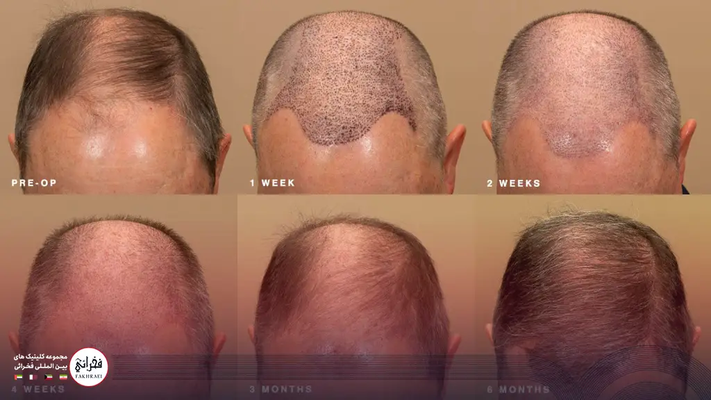 مراحل رشد مو پس از کاشت