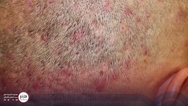 جوش سر بعد از کاشت مو