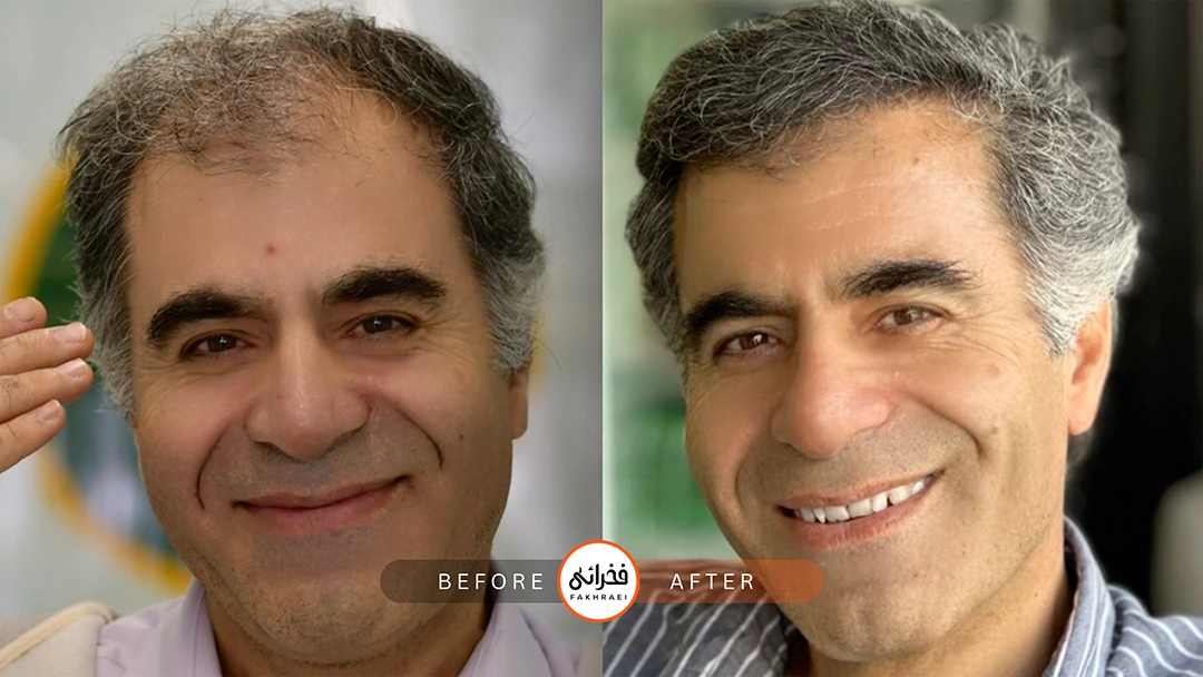 کاشت مو در سنین بالا