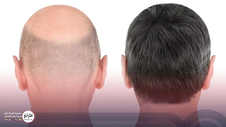 اقدامات قبل از کاشت مو