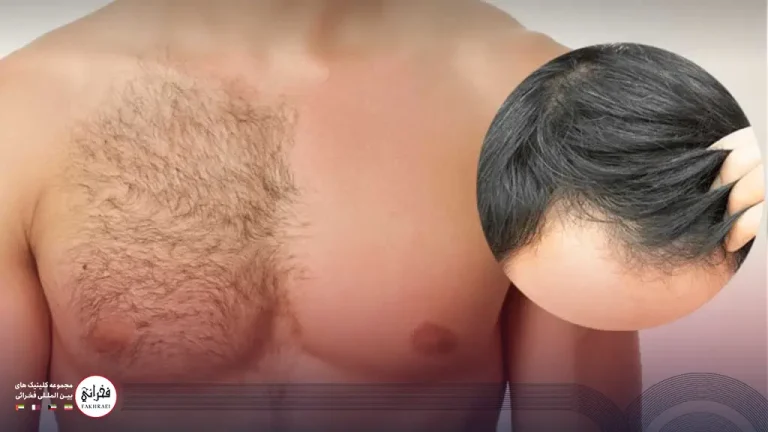 کاشت مو بدون بانک مو