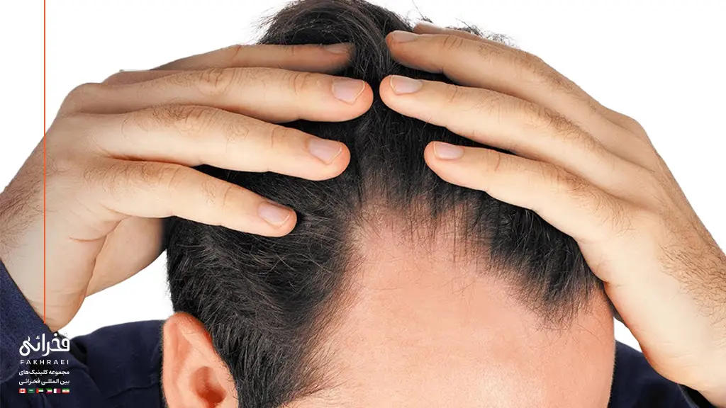 دلایل ریزش مو در شقیقه