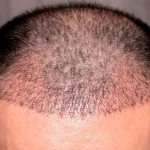 کاشت موی ناموفق