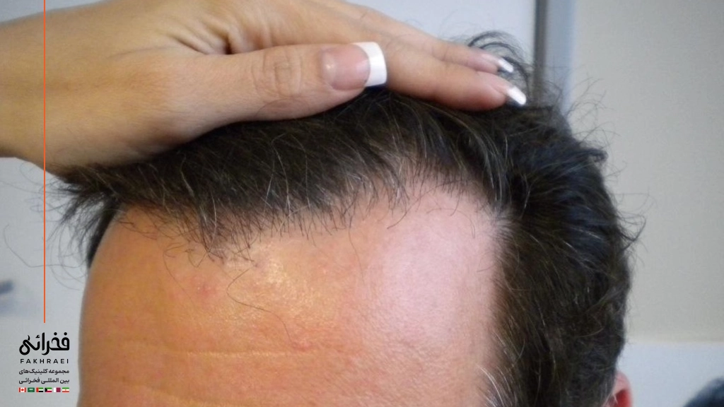 عکس کاشت موی ناموفق