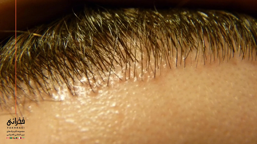 علائم کاشت موی ناموفق