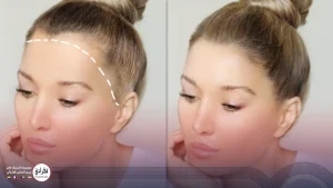 کاشت مو پیشانی