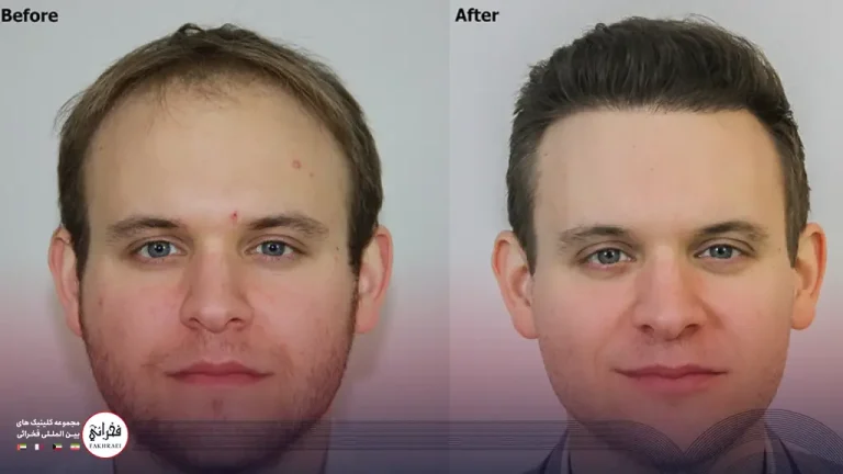 کاشت مو جلو سر برای بانوان و آقایان